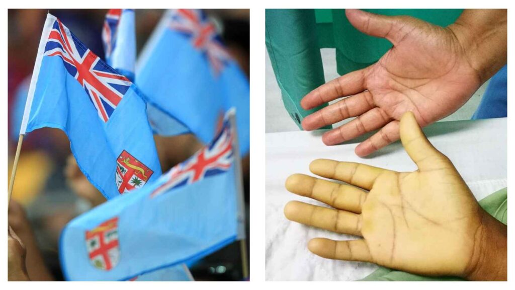 Fijian flag & Comparison between healthy and anaemic hands